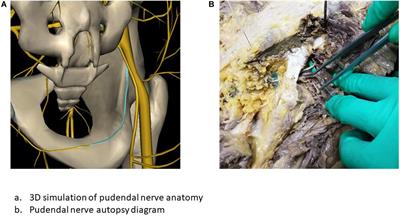 Neuromodulation of the Pudendal Nerve Assisted by 3D Printed: A New Method of Neuromodulation for Lower Urinary Tract Dysfunction